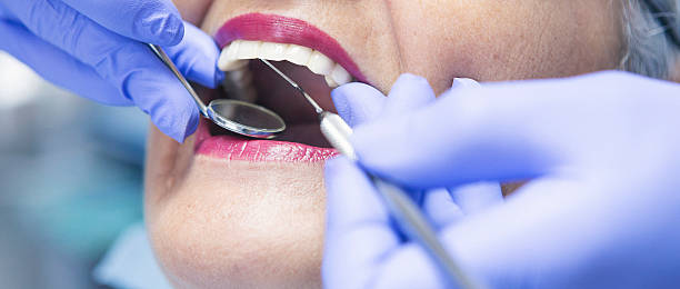Best Knocked-Out Tooth (Avulsed Tooth) Treatment in Bryant, WA